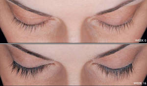 latisse2.jpg